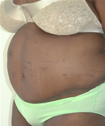 Body Contouring After Photo by John Thomassen, MD; Fort Lauderdale, FL - Case 20780