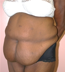 Body Contouring Before Photo by John Thomassen, MD; Fort Lauderdale, FL - Case 20780