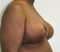 Breast Reduction After Photo by John Thomassen, MD; Fort Lauderdale, FL - Case 20782