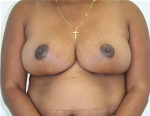 Breast Reduction After Photo by John Thomassen, MD; Fort Lauderdale, FL - Case 20783