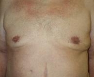 Male Breast Reduction After Photo by John Thomassen, MD; Fort Lauderdale, FL - Case 20785