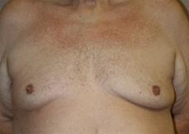 Male Breast Reduction Before Photo by John Thomassen, MD; Fort Lauderdale, FL - Case 20785