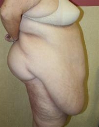 Body Contouring Before Photo by John Thomassen, MD; Fort Lauderdale, FL - Case 20786