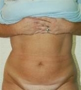 Liposuction After Photo by John Thomassen, MD; Fort Lauderdale, FL - Case 20814