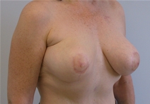 Breast Reconstruction After Photo by John Thomassen, MD; Fort Lauderdale, FL - Case 20884