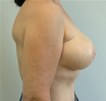 Breast Reconstruction After Photo by John Thomassen, MD; Fort Lauderdale, FL - Case 20884