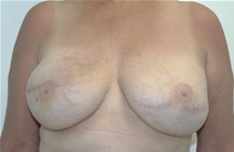 Breast Reconstruction After Photo by John Thomassen, MD; Fort Lauderdale, FL - Case 20885