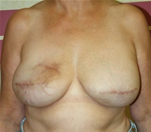 Breast Reconstruction Before Photo by John Thomassen, MD; Fort Lauderdale, FL - Case 20885