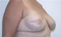 Breast Reconstruction After Photo by John Thomassen, MD; Fort Lauderdale, FL - Case 20885