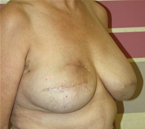 Breast Reconstruction Before Photo by John Thomassen, MD; Fort Lauderdale, FL - Case 20885