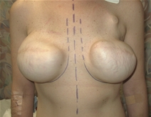 Breast Reconstruction After Photo by John Thomassen, MD; Fort Lauderdale, FL - Case 20886