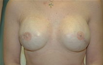 Breast Reconstruction After Photo by John Thomassen, MD; Fort Lauderdale, FL - Case 20886