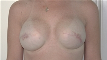 Breast Reconstruction Before Photo by John Thomassen, MD; Fort Lauderdale, FL - Case 20886