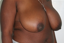 Breast Reduction Before Photo by John Thomassen, MD; Fort Lauderdale, FL - Case 20887