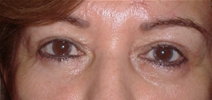 Eyelid Surgery After Photo by John Thomassen, MD; Fort Lauderdale, FL - Case 21770