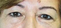 Eyelid Surgery Before Photo by John Thomassen, MD; Fort Lauderdale, FL - Case 21770