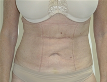 Liposuction After Photo by John Thomassen, MD; Fort Lauderdale, FL - Case 21773