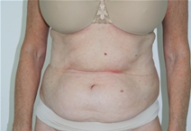 Liposuction Before Photo by John Thomassen, MD; Fort Lauderdale, FL - Case 21773