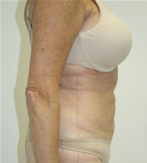 Liposuction After Photo by John Thomassen, MD; Fort Lauderdale, FL - Case 21773