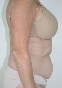 Liposuction Before Photo by John Thomassen, MD; Fort Lauderdale, FL - Case 21773