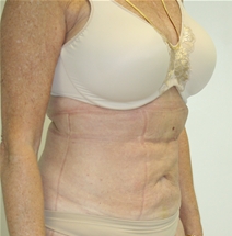 Liposuction After Photo by John Thomassen, MD; Fort Lauderdale, FL - Case 21773