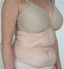 Liposuction Before Photo by John Thomassen, MD; Fort Lauderdale, FL - Case 21773