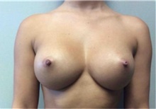 Breast Augmentation After Photo by Mariam Awada, MD, FACS; Southfield, MI - Case 33919
