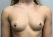 Breast Augmentation Before Photo by Mariam Awada, MD, FACS; Southfield, MI - Case 33919