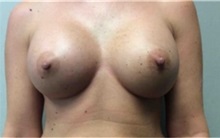 Breast Augmentation After Photo by Mariam Awada, MD, FACS; Southfield, MI - Case 33922