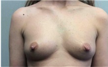 Breast Augmentation Before Photo by Mariam Awada, MD, FACS; Southfield, MI - Case 33922
