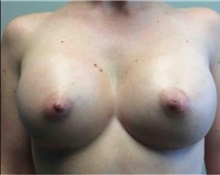 Breast Augmentation After Photo by Mariam Awada, MD, FACS; Southfield, MI - Case 33927