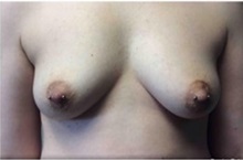 Breast Augmentation Before Photo by Mariam Awada, MD, FACS; Southfield, MI - Case 33947