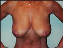 Breast Lift Before Photo by Mariam Awada, MD, FACS; Southfield, MI - Case 33948