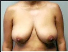 Breast Lift Before Photo by Mariam Awada, MD, FACS; Southfield, MI - Case 33950
