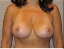 Breast Lift After Photo by Mariam Awada, MD, FACS; Southfield, MI - Case 33952