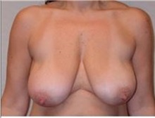 Breast Lift Before Photo by Mariam Awada, MD, FACS; Southfield, MI - Case 33952