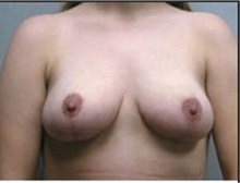 Breast Lift After Photo by Mariam Awada, MD, FACS; Southfield, MI - Case 33957
