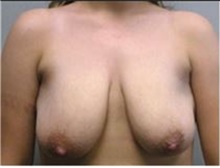 Breast Lift Before Photo by Mariam Awada, MD, FACS; Southfield, MI - Case 33957
