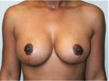 Breast Lift After Photo by Mariam Awada, MD, FACS; Southfield, MI - Case 33958