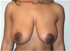 Breast Lift Before Photo by Mariam Awada, MD, FACS; Southfield, MI - Case 33958