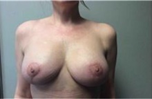 Breast Implant Removal After Photo by Mariam Awada, MD, FACS; Southfield, MI - Case 38836