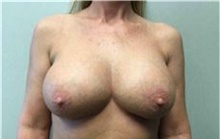 Breast Implant Removal After Photo by Mariam Awada, MD, FACS; Southfield, MI - Case 38838