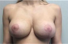 Breast Implant Removal After Photo by Mariam Awada, MD, FACS; Southfield, MI - Case 38839