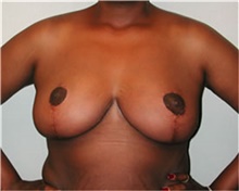 Breast Reduction After Photo by Mariam Awada, MD, FACS; Southfield, MI - Case 38860
