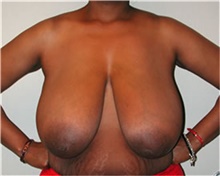 Breast Reduction Before Photo by Mariam Awada, MD, FACS; Southfield, MI - Case 38860
