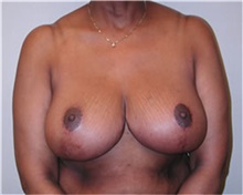 Breast Reduction After Photo by Mariam Awada, MD, FACS; Southfield, MI - Case 38861