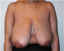 Breast Reduction Before Photo by Mariam Awada, MD, FACS; Southfield, MI - Case 38861
