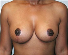 Breast Reduction After Photo by Mariam Awada, MD, FACS; Southfield, MI - Case 38864