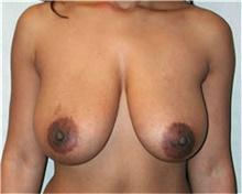 Breast Reduction Before Photo by Mariam Awada, MD, FACS; Southfield, MI - Case 38864