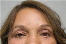 Brow Lift After Photo by Mariam Awada, MD, FACS; Southfield, MI - Case 38880